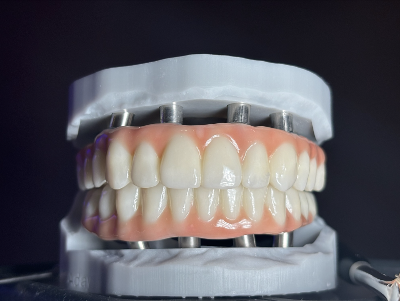 A white dental model of a jaw featuring a set of implants and a prototype prosthetic bridge